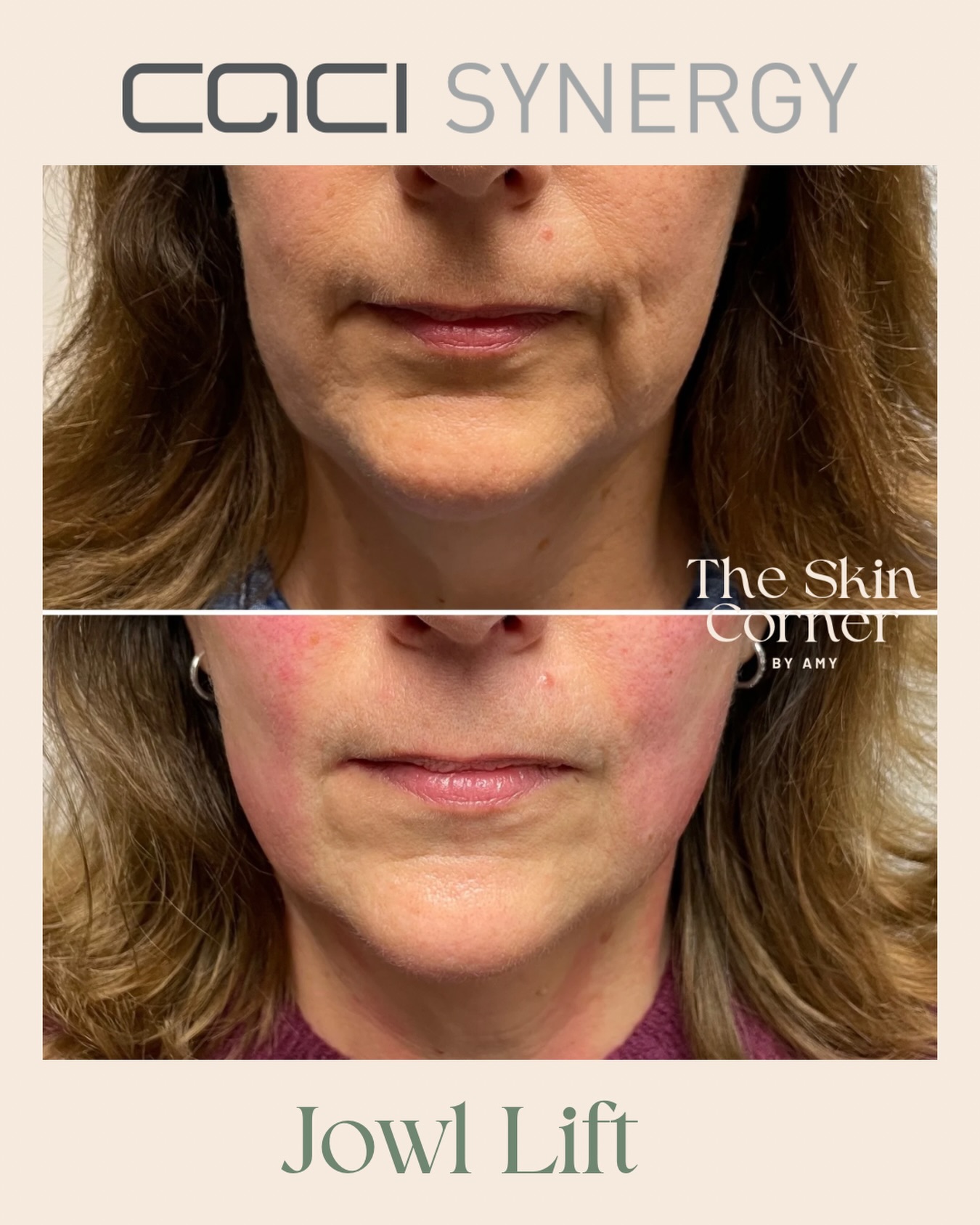 CACI Synergy Jowl Lift before and after