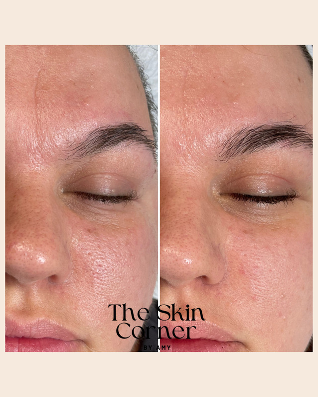 Skin before and after treatment, side by side