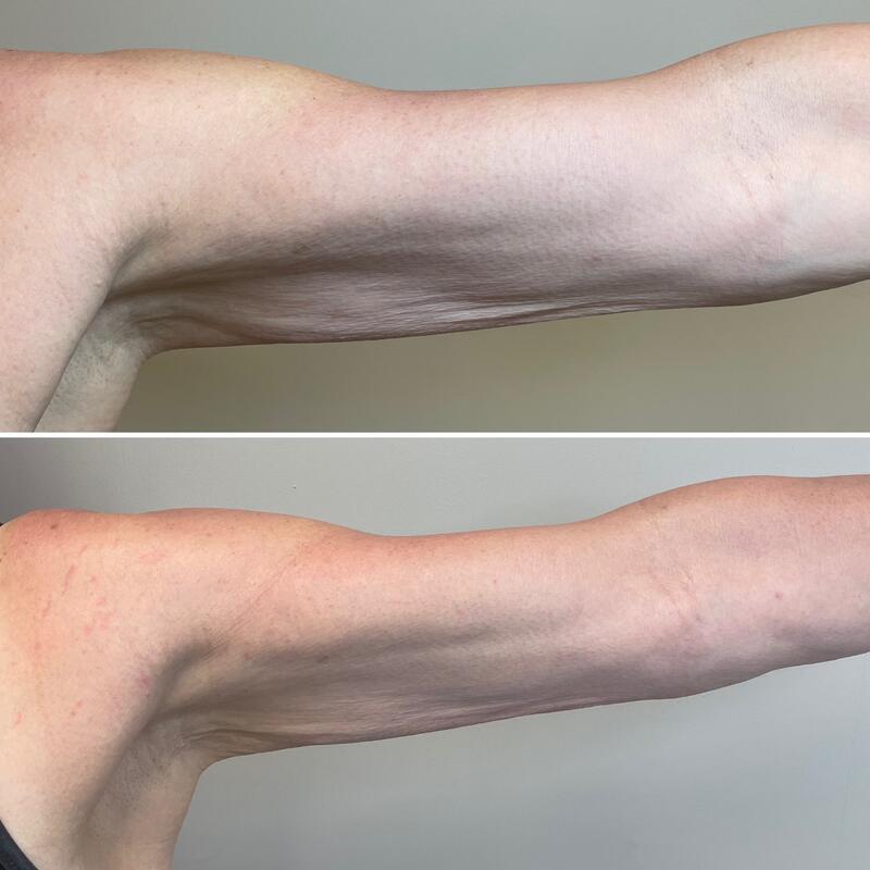Upper arm before and after, top and bottom